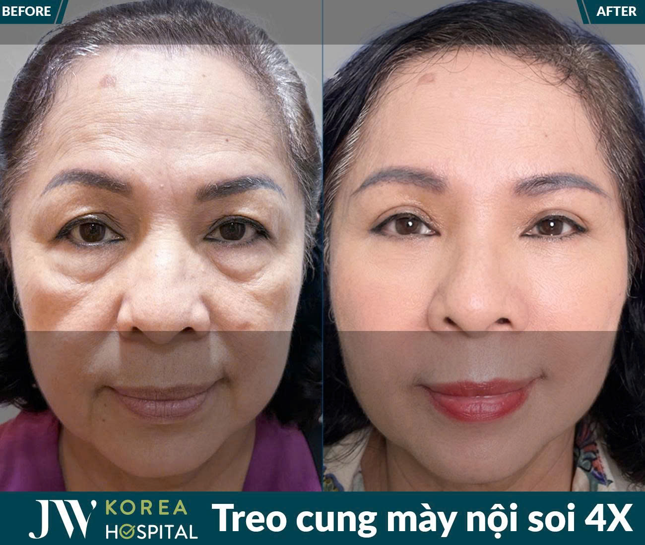 Treo chân mày nội soi 4X
