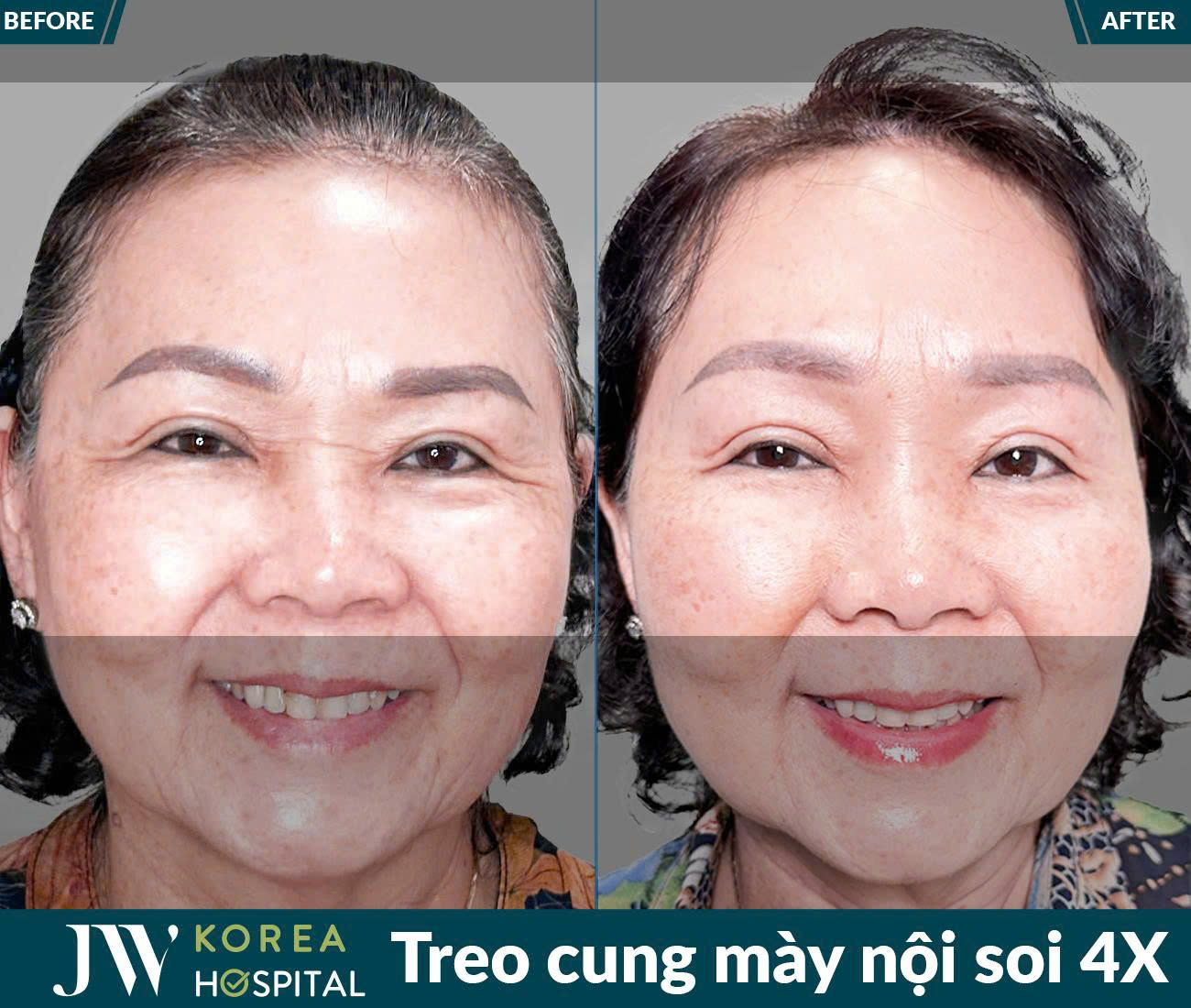 Treo chân mày nội soi 4X