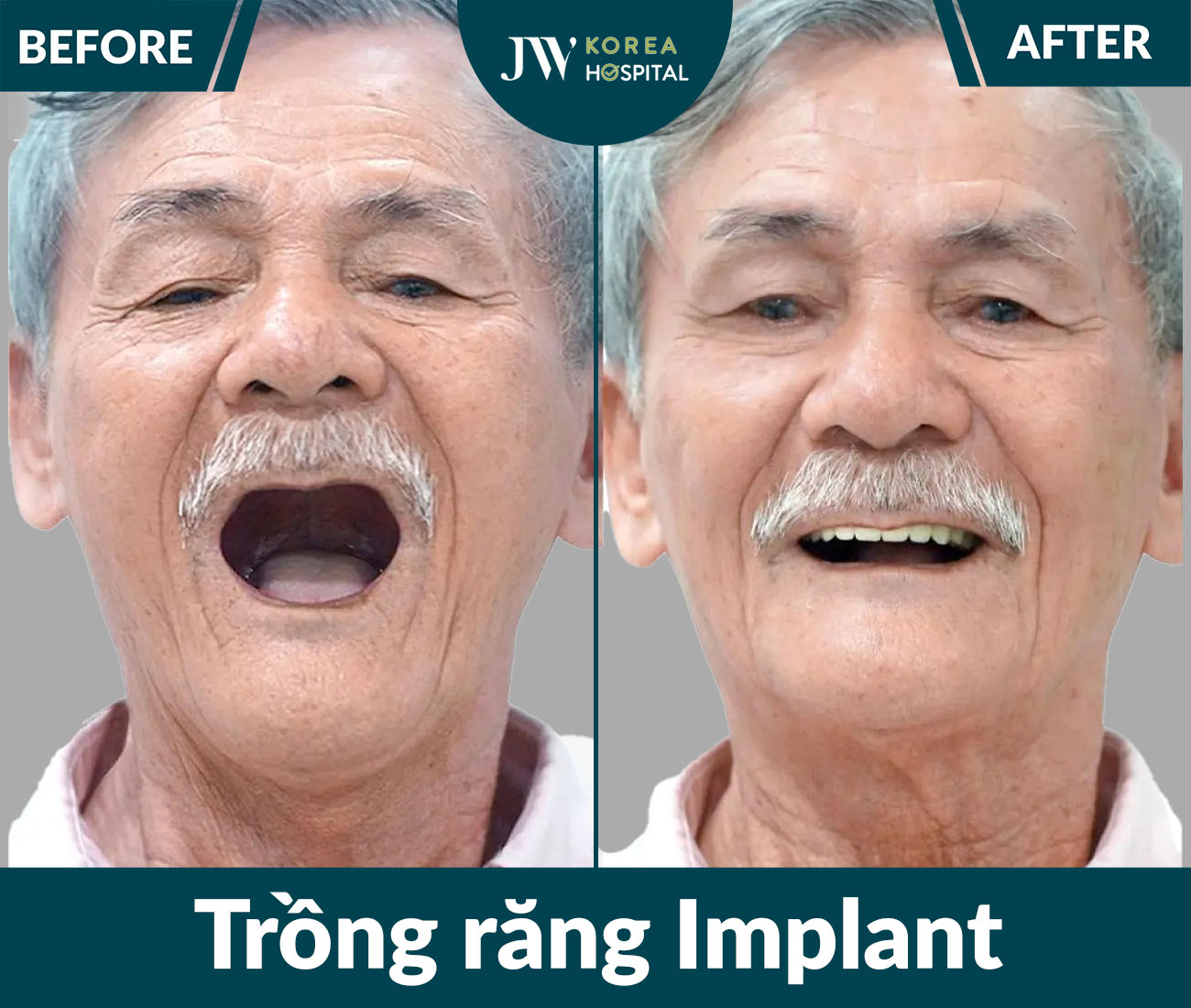 Trồng răng Implant