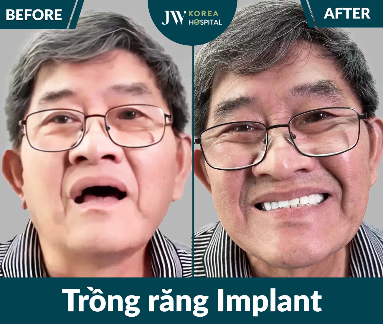 Trồng răng Implant