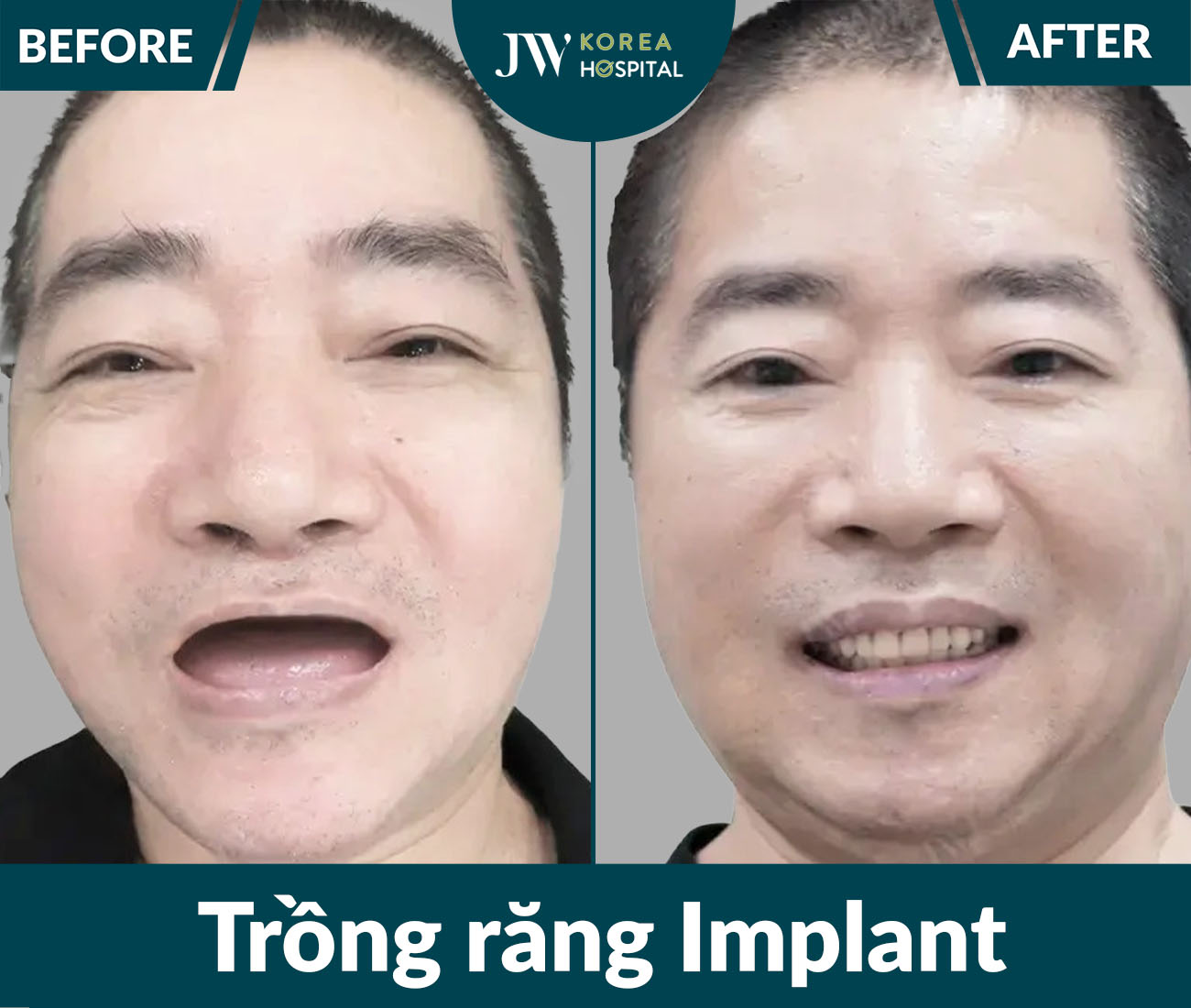 Trồng răng Implant