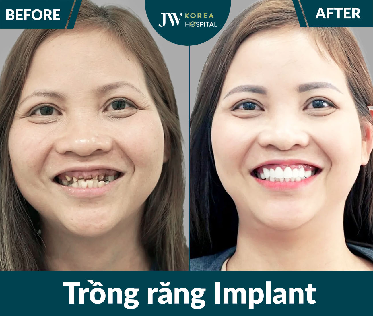 Trồng răng Implant