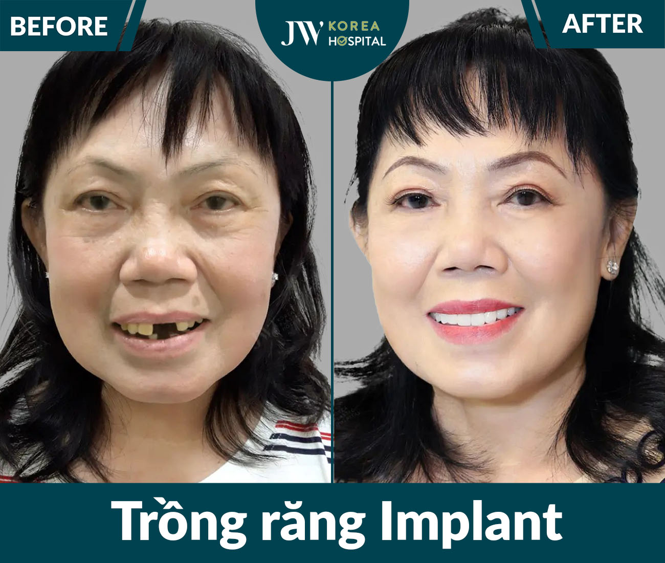 Trồng răng Implant