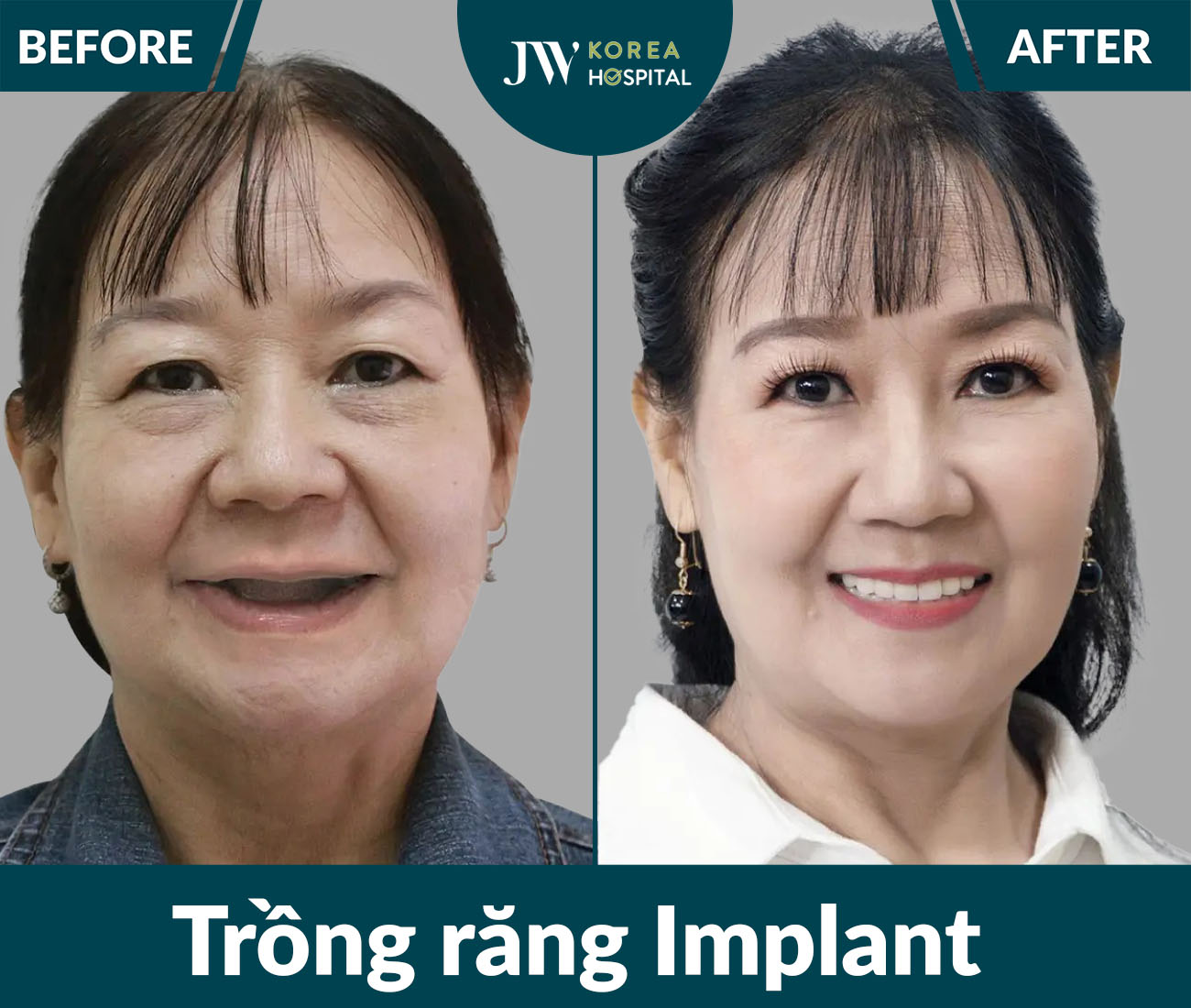 Trồng răng Implant