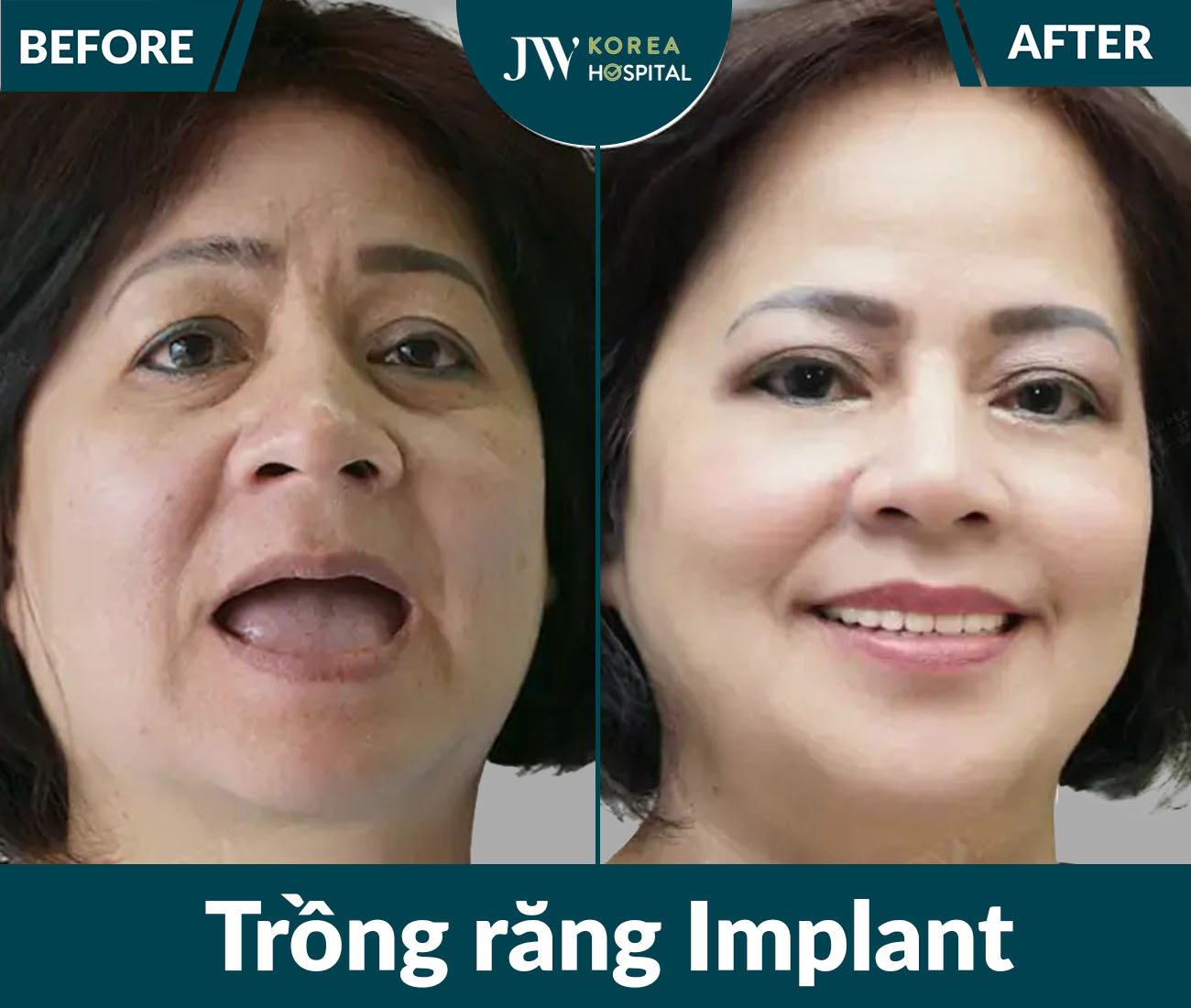 Trồng răng Implant