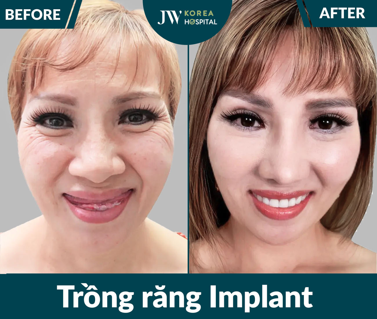 Trồng răng Implant