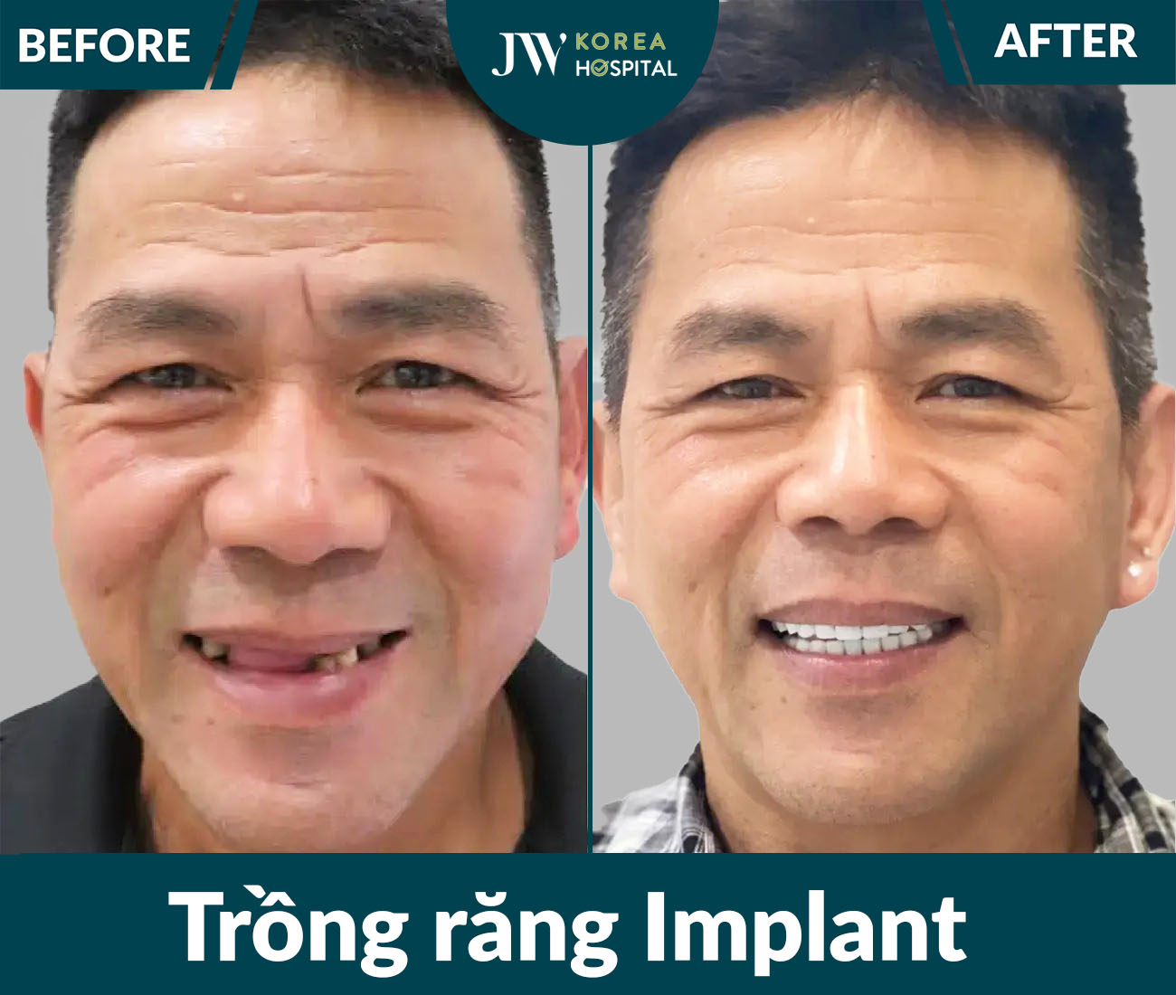 Trồng răng Implant