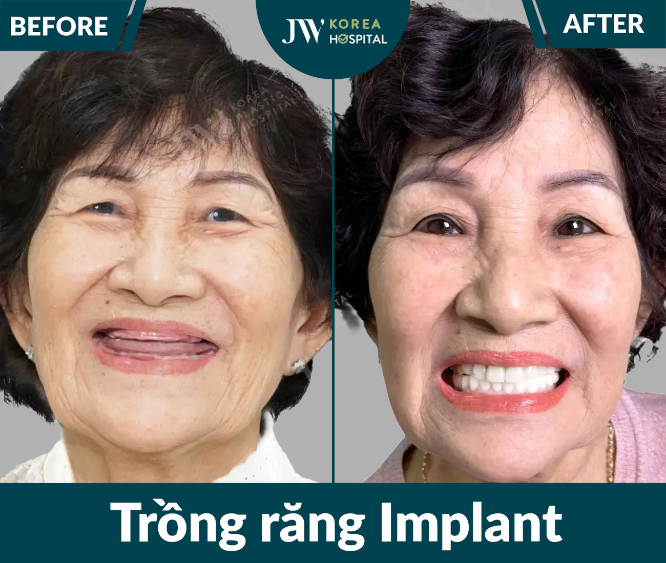 Trồng răng Implant