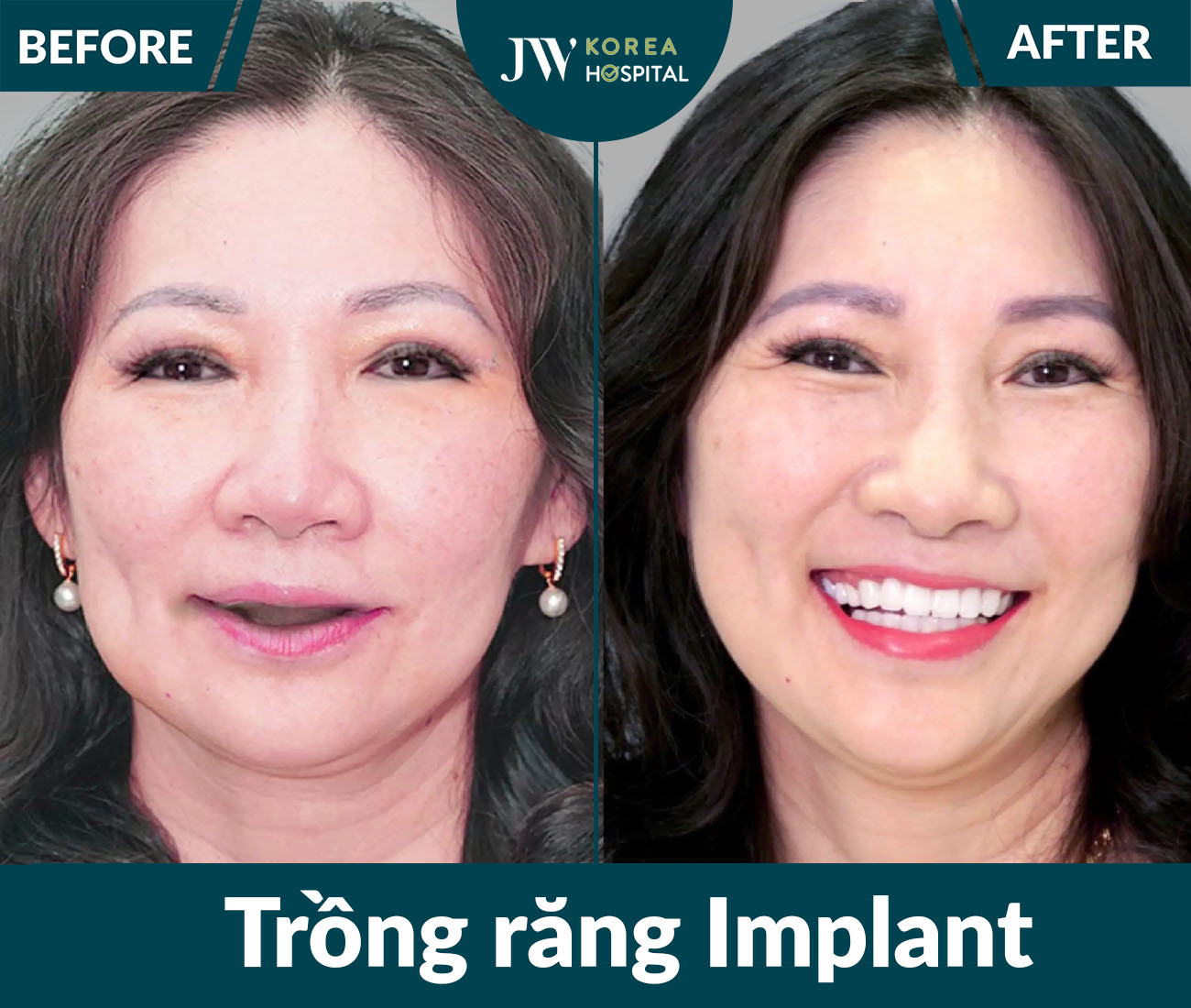 Trồng răng Implant