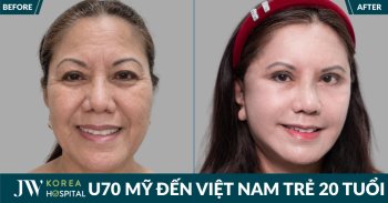 Người phụ nữ từ chối Y tế Mỹ để đến Việt Nam căng da mặt SMAS PRO