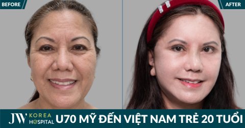 Người phụ nữ từ chối Y tế Mỹ để đến Việt Nam căng da mặt SMAS PRO