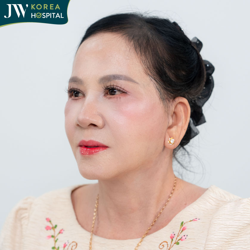 Đường mổ siêu mảnh, sẹo tàng hình