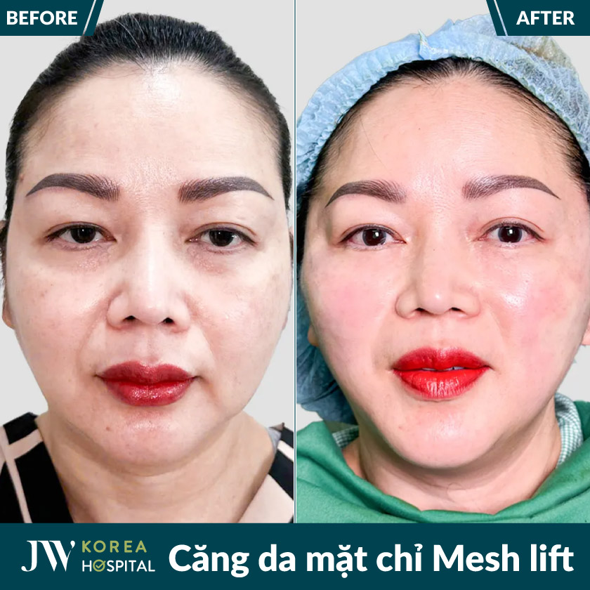 Hình ảnh khách hàng trước và sau căng da mặt chỉ Mesh Lift tại bệnh viện JW