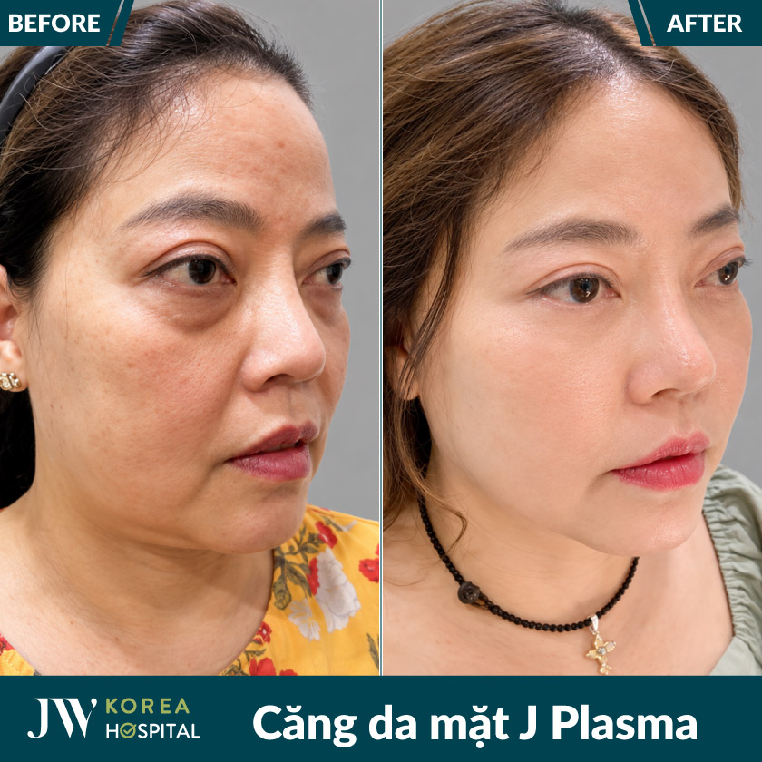 Hình ảnh khách hàng trước và sau Căng da mặt J Plasma tại bệnh viện JW
