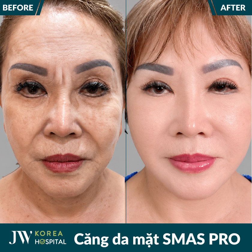 Hình ảnh khách hàng trước và sau căng da mặt SMAS PRO tại bệnh viện JW