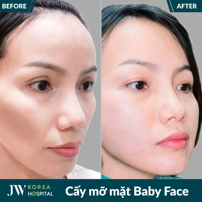Hình ảnh khách hàng trước và sau Cấy mỡ mặt Baby Face tại bệnh viện JW