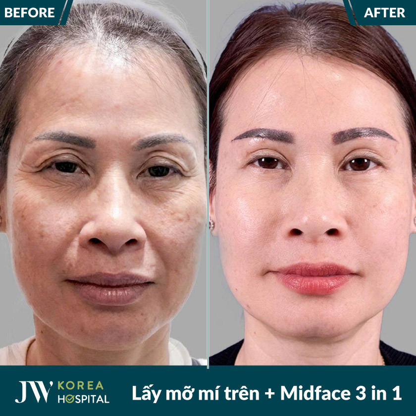 Hình ảnh khách hàng trước và sau lấy mỡ da thừa mí trên và Midface 3 in 1 tại bệnh viện JW