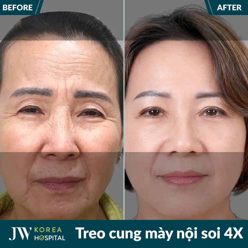 Hình ảnh khách hàng trước và sau treo chân mày nội soi 4X tại bệnh viện JW