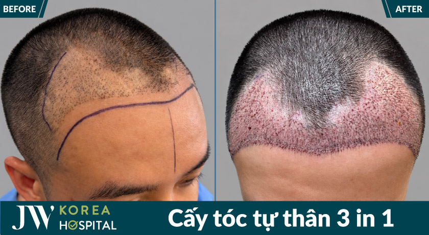 Hình ảnh sau khi cấy tóc tại JW
