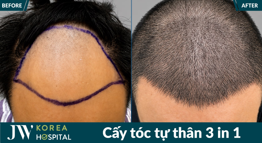 Hình ảnh trước sau khi cấy tóc tại JW