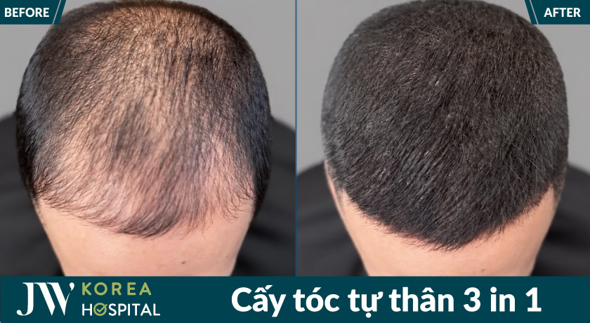 Tình trạng thực tế sau khi cấy tóc tại JW