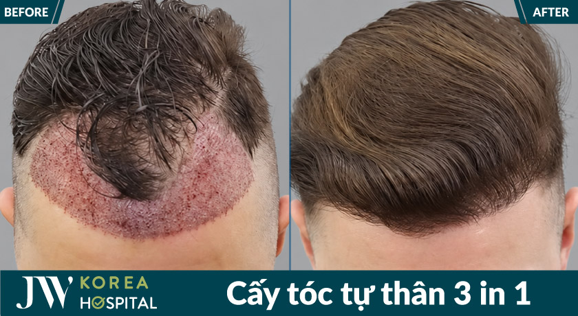 Hình ảnh trước và sau khi cấy tóc tự thân tại JW