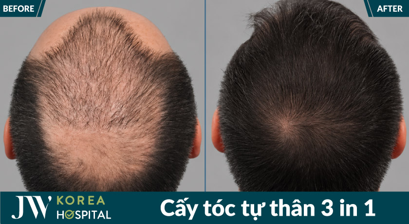 Hình ảnh trước sau Cấy tóc tự thân 3 in 1 tại JW