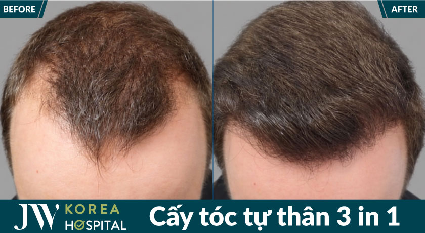 Kết quả cấy tóc tự thân tại JW
