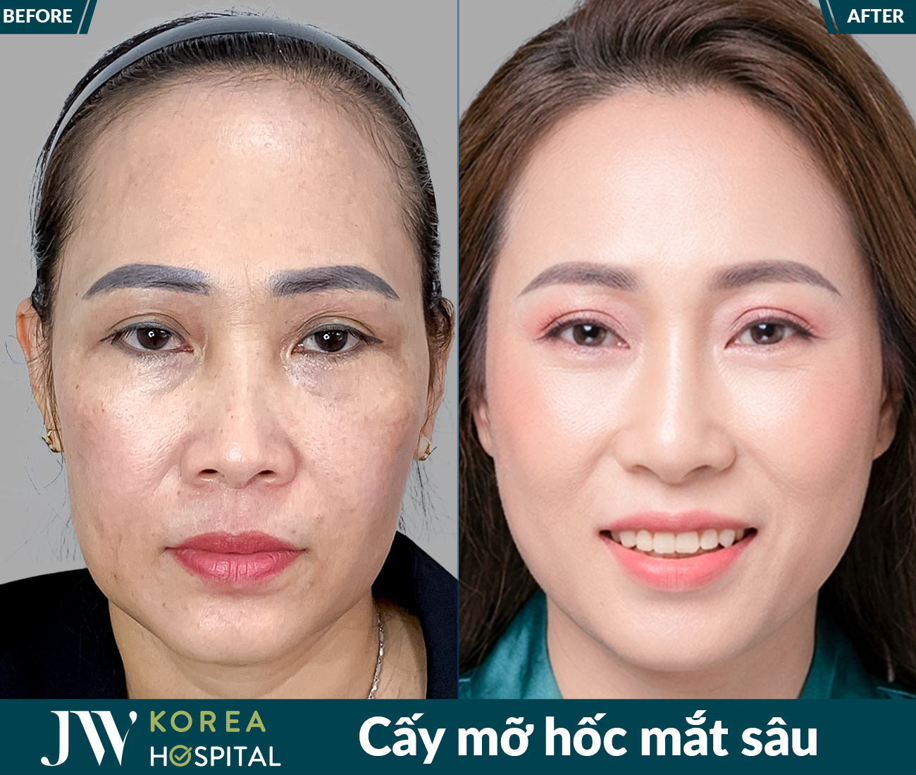 Cấy mỡ mặt
