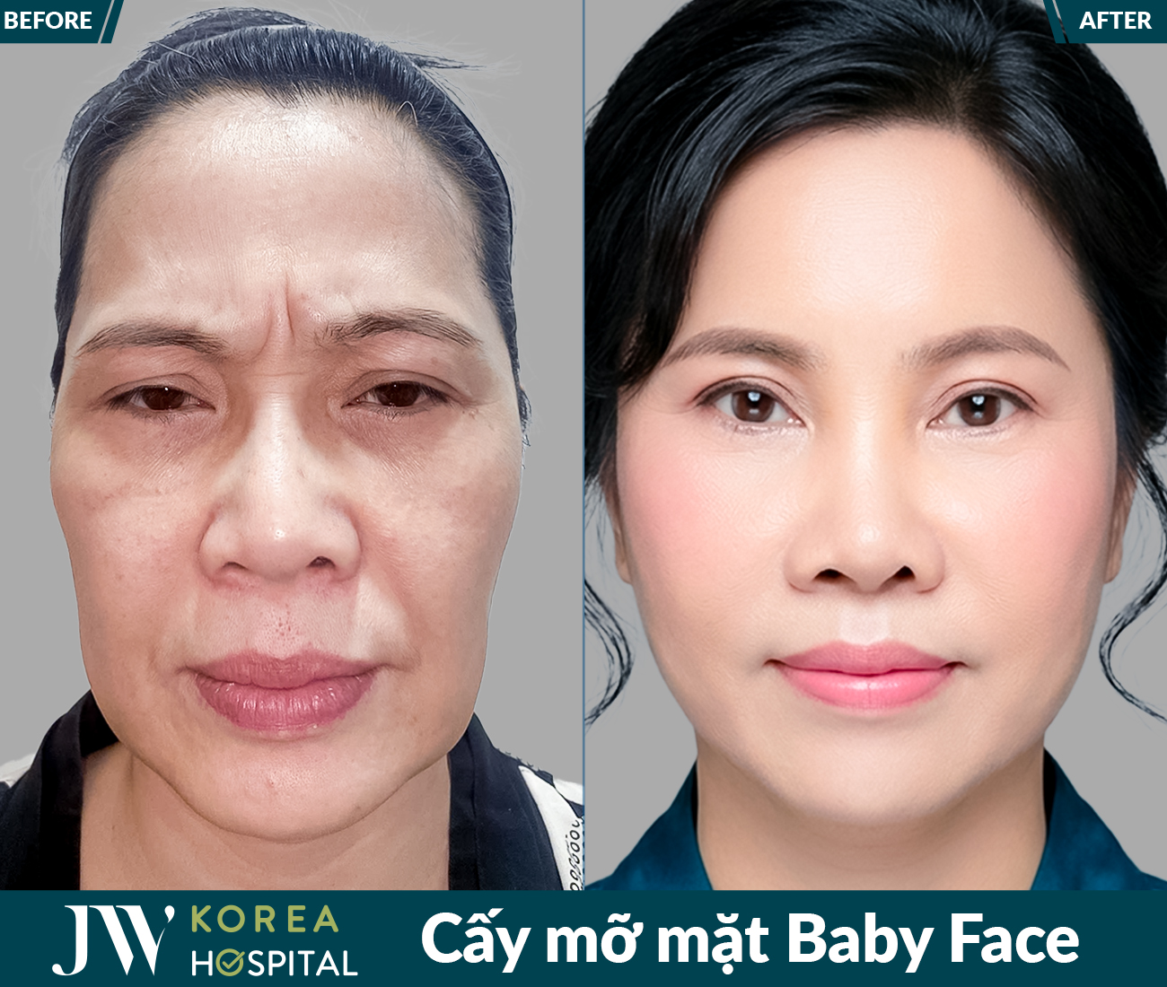 Cấy mỡ mặt