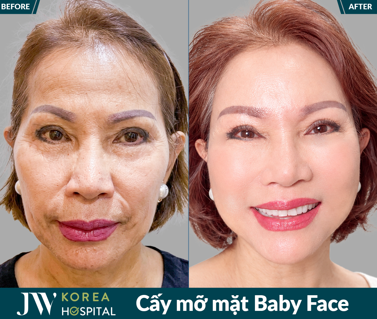 Cấy mỡ mặt