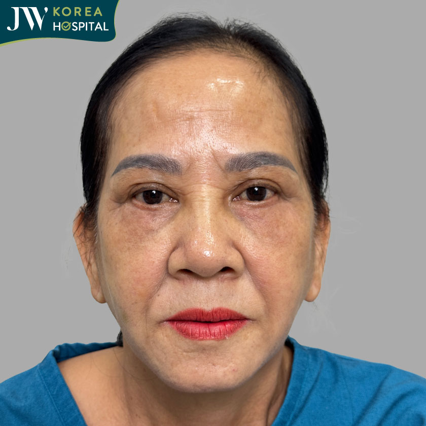 Gương mặt có vùng lõm hóp
