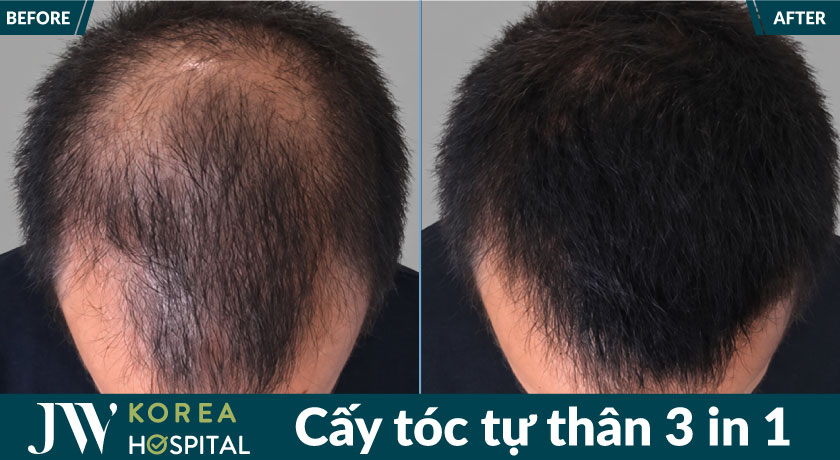 Sự thay đổi sau khi cấy tóc tại JW