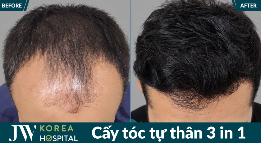 Trước và sau khi cấy tóc tại JW