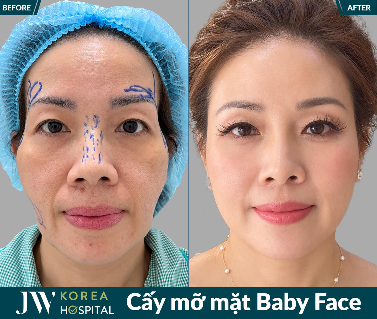 Cấy mỡ mặt