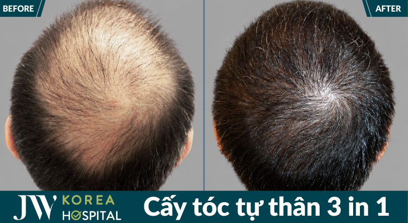 Kết quả thực tế sau cấy tóc tự thân 3 in 1 tại JW