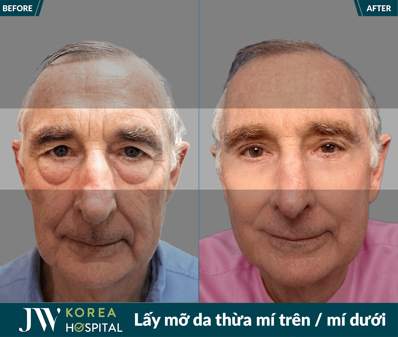 Lấy mỡ da thừa mí trên / mí dưới