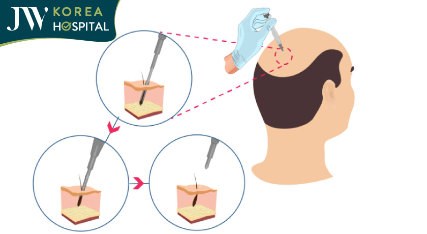 DHI cấy nang tóc bằng bút chuyên dụng