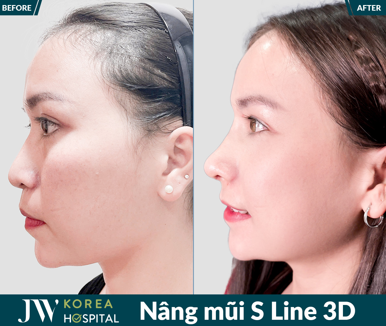 Nâng mũi S Line 3D