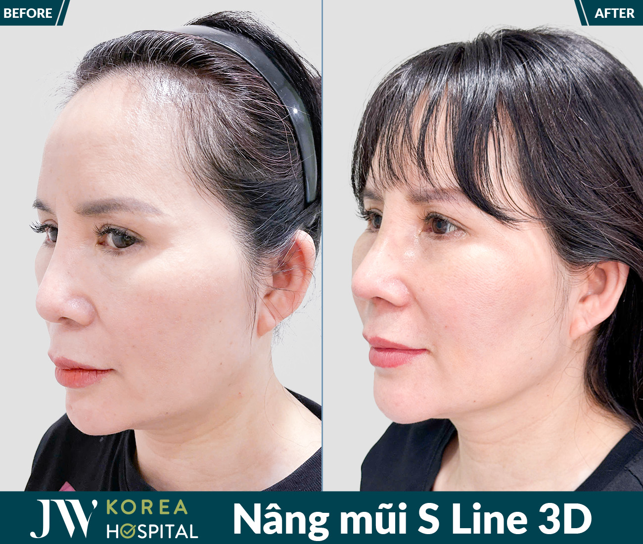 Nâng mũi S Line 3D