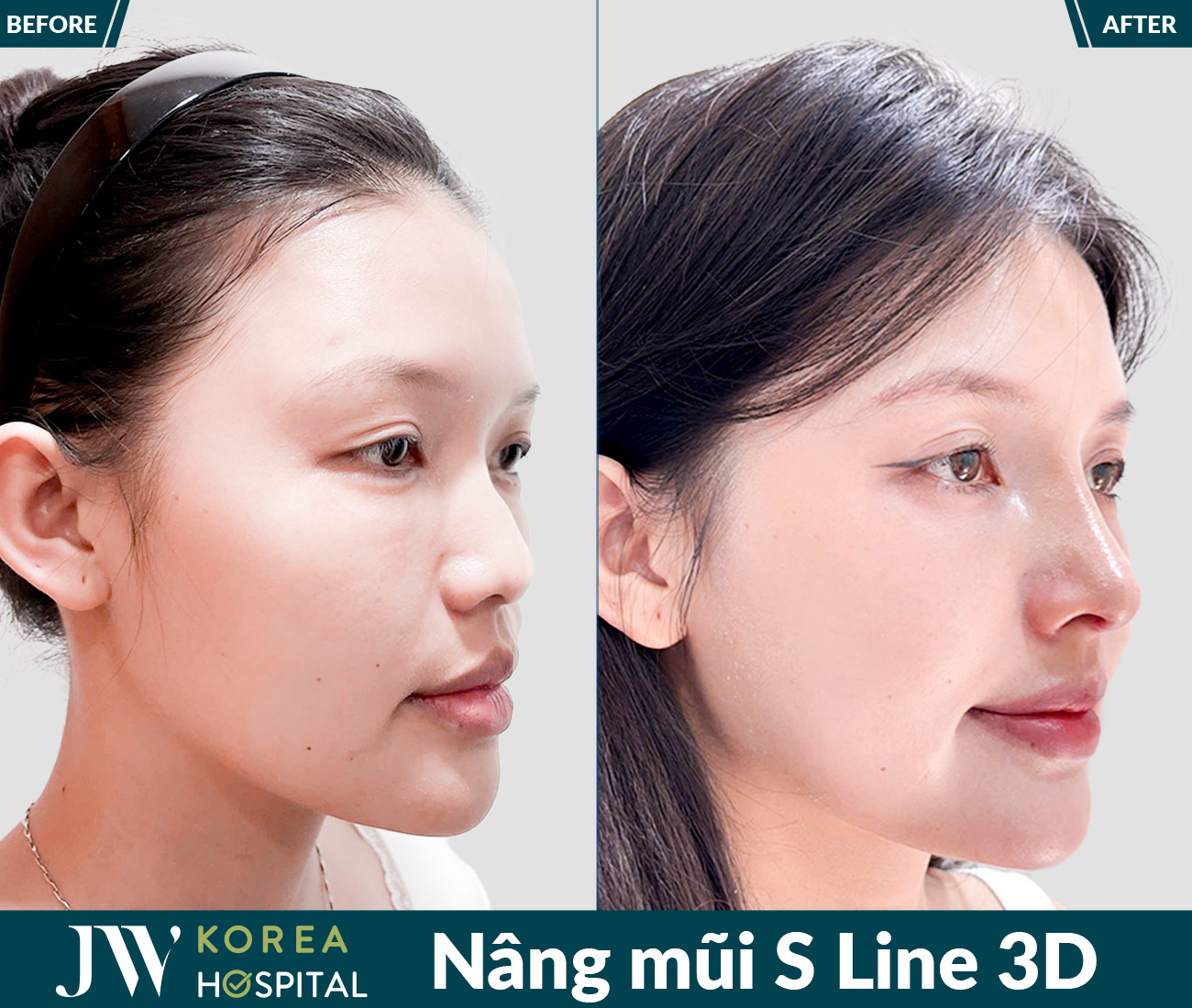 Nâng mũi S Line 3D