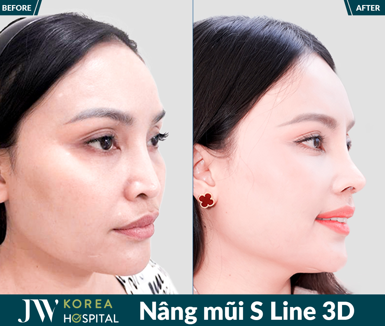Nâng mũi S Line 3D