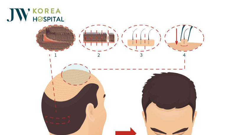 Quá trình bác sĩ JW thực hiện cấy tóc