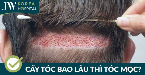 Cấy tóc bao lâu thì mọc? Lộ trình mọc tóc sau cấy như thế nào?