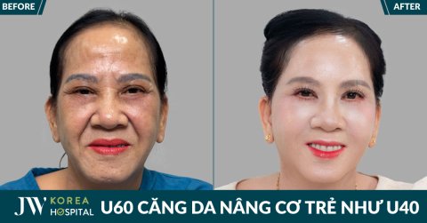 Quý bà Bình Dương được chồng dắt đến JW căng da mặt SMAS PRO trẻ 20 tuổi