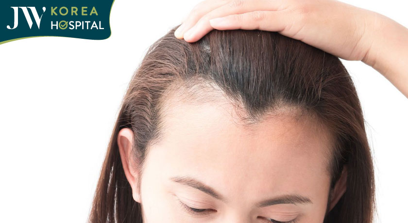 Tình trạng hói tóc chữ M