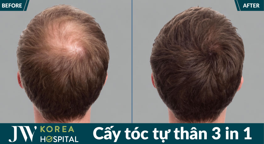 Hình ảnh minh họa kết quả cấy tóc tự thân