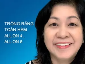 Trồng răng toàn hàm all on 4, all on 6