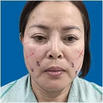 Căng da mặt Mesh Lift