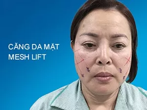 Căng da mặt Mesh Lift